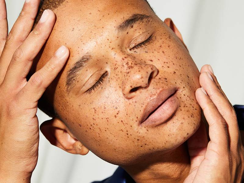 Person with freckles holding head and chin